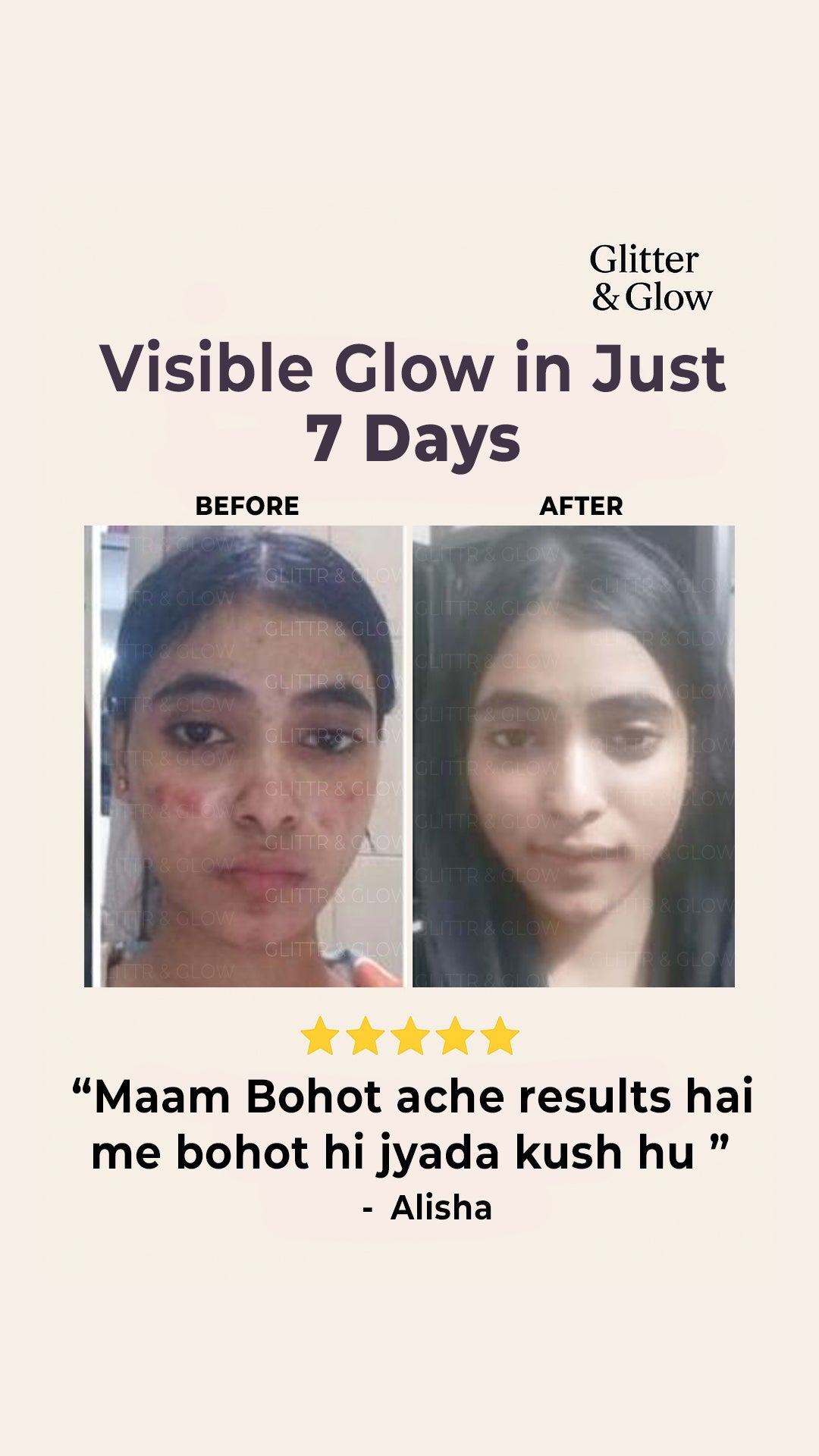 Anti - Acne & Glow Kit - Glitter and Glow